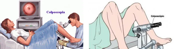 Biopsia cervical dirigida