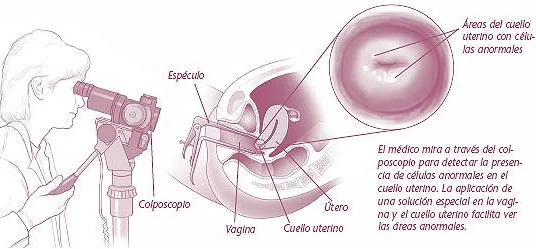 Resultado y seguimiento — Colposcopia