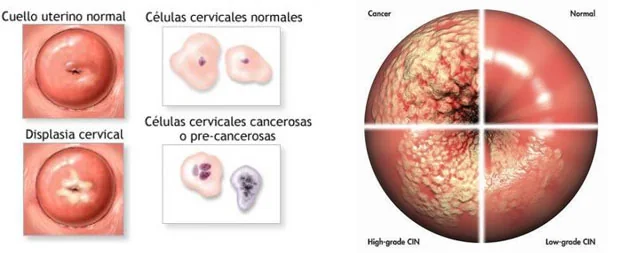Detalle clínico — Colposcopia